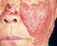 Туберкулез кожи волосистой головы thumbnail