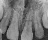 Перелом корня зуба у детей лечение thumbnail