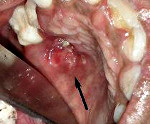 Туберкулез в полости рта история болезни thumbnail