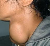 Синдром зоба и узловая патология щитовидной железы thumbnail