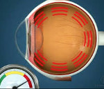 Вторичная глаукома патогенез клиника лечение thumbnail