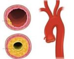 Атеросклероз грудной отдела аорты и коронарных thumbnail