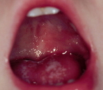 Лечение ожога слизистой рта в домашних условиях thumbnail
