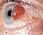 Лечение при новообразовании хориоидеи глаза thumbnail