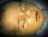 Анемии и желтухи новорожденных thumbnail