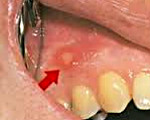 Что такое стоматит стоматология thumbnail