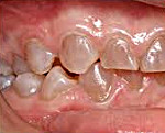 Цвета зубов при синдроме стентона капдепона thumbnail