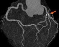 Неинвазивная диагностика атеросклероза и кальциноза коронарных артерий thumbnail