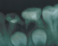 Лечение хронического гранулирующего периодонтита молочных зубов thumbnail