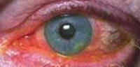 Вирусные заболевания роговицы глаза thumbnail