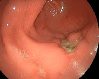 Пептическая язва анастомоза после резекции желудка лечение thumbnail