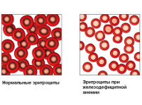 Что такое анемия и хлороз thumbnail