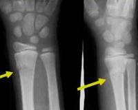 Перелом лучевой кости у ребенка признаки thumbnail