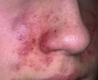 От чего возникает дерматит и чем его лечить thumbnail
