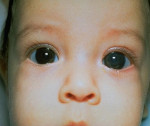 Врожденная глаукома глазное дно thumbnail