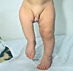 Синдром нижних конечностей у ребенка thumbnail