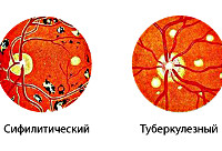 Хориоретинит глаза код по мкб 10 thumbnail