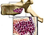 Опухоль гемангиома позвоночника при грыже thumbnail