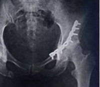Перелом лонной кости и дна вертлужной впадины thumbnail