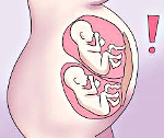 Синдром плацентарной трансфузии при одноплодной беременности что это thumbnail