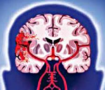 Геморрагический инсульт головного мозга клиника thumbnail
