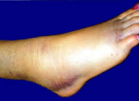 Реактивный артрит правого голеностопного сустава thumbnail