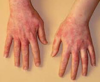 Аллергический дерматит на латекс thumbnail