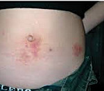 Что может быть причиной дерматита thumbnail