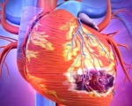 Признаки безболевого инфаркта миокарда thumbnail
