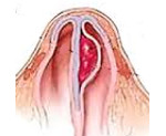 Гематома носовой перегородки симптомы thumbnail