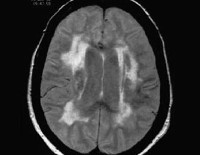 Болезнь паркинсона что это такое атеросклероз сосудов головного мозга thumbnail