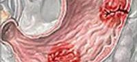 Кровотечение из верхних отделов желудочно кишечного тракта лечение thumbnail