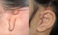 Синдром микротии атрезии слухового прохода и тугоухости thumbnail