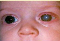 Врожденная и вторичная глаукома thumbnail