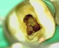 Лечение зуба с дентиклем thumbnail