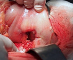Пенетрирующая язва двенадцатиперстной кишки в поджелудочную железу thumbnail