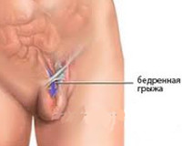 Бедренная грыжа у женщин анатомия thumbnail