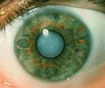 Что такое катаракта роговицы thumbnail