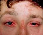 Ожоги глаз диагностика и лечение thumbnail