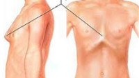 Как вылечить килевидную грудь thumbnail