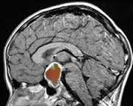 Краниофарингиома головного мозга лечение народными средствами thumbnail