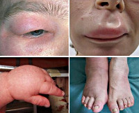 Аллергия и признаки острой аллергии thumbnail