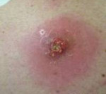 Инфекции мягких тканей и кожи инфицированная рана целлюлит ожог абсцесс thumbnail