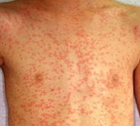 Лекарственная аллергия этиология патогенез клиника диагностика лечение thumbnail