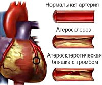 Нестабильная стенокардии и инфаркт миокарда thumbnail