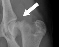 Переломы трубчатых костей эпифизарный thumbnail