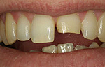Перелом зуба правильный диагноз thumbnail