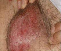 Фото болезней на влагалище и их названия thumbnail