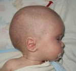 Гидроцефальный синдром у ребенка 2 года симптомы thumbnail