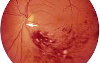Окклюзия вены сетчатки глаза лечение thumbnail